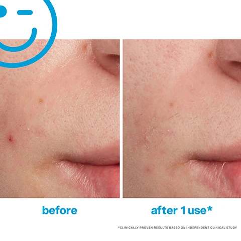 Image 1, before and after 1 use. clinically proven results based on an independent clinical study. image 2, 97% showed improvement of redness and inflammation in just 2 days. 94% showed improvement of breakouts in just 1 hour. clinically proven results based on an independent clinical study. peta approved - cruelty free.