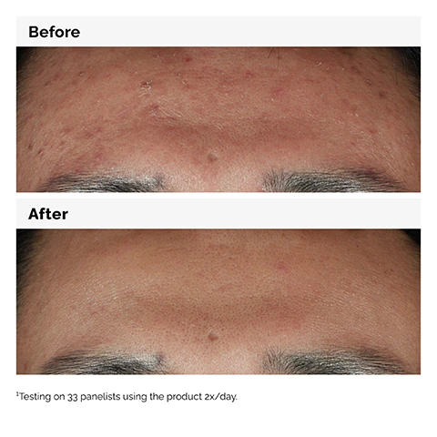 Image 1 - Image shows two close-up photos of a forehead, with the top labeled Before showing skin with blemishes and redness, and the bottom labeled After showing clearer skin; visible text at the bottom states Testing on 33 panelists using the product 2x/day.
Image 2 - A dropper bottle with a white label labeled The Ordinary contains a clear serum, alongside a glass pipette, with text that reads The Ordinarys best-seller for blemish-prone skin.
Image 3 - A close-up of a person with dark hair touching their cheek, showcasing a glowing complexion, with accompanying text that reads Boosts skin brightness and improves skin smoothness. 10% Niacinamide 1% Zinc PCA.
Image 4 - A clear glass dish containing two glistening droplets of a lightweight, translucent serum, with text indicating Niacinamide 10% + Zinc 1% Lightweight water-based serum texture.
Image 5 - Image shows a skincare routine divided into three sections: PREP with cleansers and toners, TREAT indicating water-based serums, eye serums, anhydrous solutions, and oils, and SEAL with suspensions, moisturizers, and SPF, displaying various skincare product textures.
