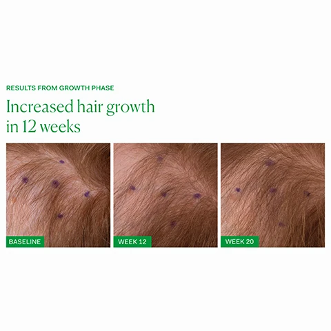 Image 1, results from growth phase. increased hair growth in 12 weeks. baseline vs week 12 vs week 20. image 2, increased hair growth in 12 weeks. before and after. image 3, 90% reduction in hair shedding. 87% reduction in hair breakage. 40% increase in hair growth. image 3, treat hair loss. inner growth phase - women looking to address hair shedding and support new hair growth. clinically proven to increase hair growth and reduce breakage. three capsules daily with food. supa_thick scalp serum - anyone looking to address hair shedding and support new hair growth. before washing, divide hair into sections, apply directly to scalp and massage in. leave for 20 minutes and then wash hair as normal. image 4, old packaging vs new packaging. as our new packaging phases in sustainably, you may receive either out old or new jar and box. inside the jar it's the same formula you know and love.