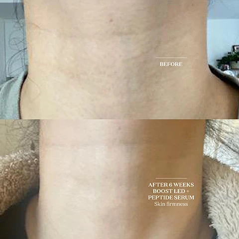 image 1, before and after 6 weeks boost LED and peptide serum - skin firmness. image 2, where can i apply it? wherever you need it most. using the adjustable straps, you can wear the collar on your neck, forehead, lower face and hairline, to rejuvenate the skin and stimulate blood flow to the scalp. is it suitable for teens? the collar is dieal for teens as it can be used to target blemish-prone areas on the face, neck and back. image 3, boost LEF collar founder notes, hannah measures said - we developed the collar in response to high demand from mask devotees. the compact but powerful band of LED not only smooths, plumps and corrects the skin but relieves muscular tension an added bonus for tech neck sufferers.