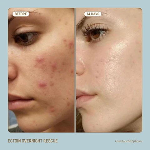 image 1, before and after 14 days. ectoin overnight rescue. unretouched photos. image 2, skin moisture barrier. dry + damaged allowed toxins and irritants easily pass the skin barrier. healthy and hydrated effectively defends skin against damage and aggressors. image 3, night time renewal routine. step 1 = cleanse with antioxidant cleansing oil. step 2 = visibly lift under eyes with marine algae eye cream. step 3 = instantly plump skin with copper peptide rapid plumping serum. step 4 = repair and replenish barrier with ectoin overnight rescue. image 4, ectoin education. what is ectoin? a clinically proven, bio-fermented molecule known to fight environmental stressors and bind moisture to the skin. what are the benefits? ectoin replenishes skin's moisture barrier after daytime damage for visibly improved texture, tone and hydration overnight. why use ectoin at night? it works optimally with skin's natural overnight reparative cycle to replenish moisture and prevent transepidermal water loss while you sleep.